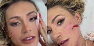 Andressa Urach com o rosto sangrando